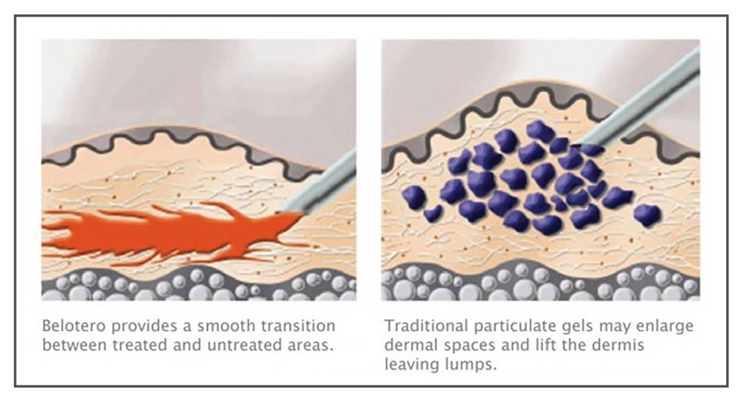 董氏奇穴一针治疗黑眼圈,熊猫针一针就能去掉黑眼圈吗