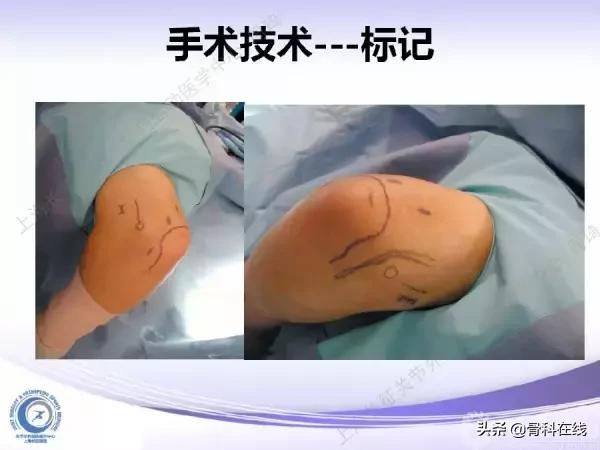 肘关节镜手术后引流,肘关节镜微创手术