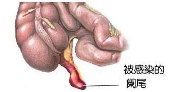 妊娠期急性阑尾炎最佳治疗方法,妊娠期急性阑尾炎