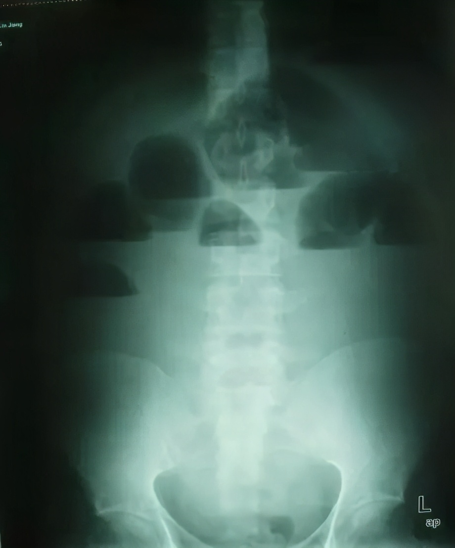 拉不出便便怎么办,拉不出便便怎么办该买什么