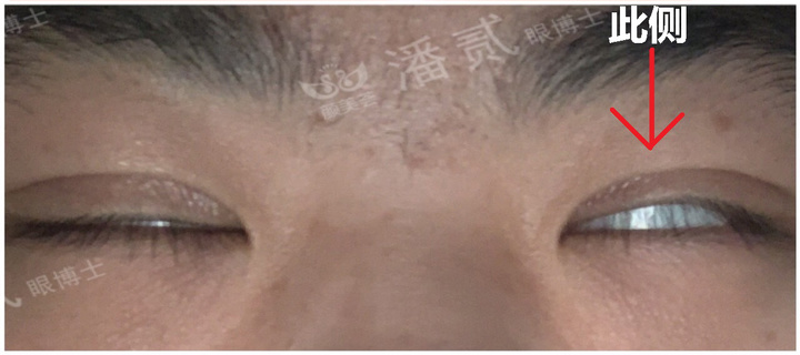 重度上睑下垂术后为什么闭不上眼睛？闭眼不全怎么护理好？