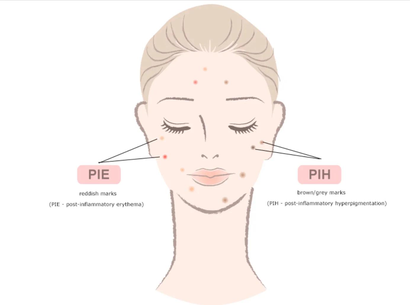 疮好后有红色疤痕怎么消除,长疮留下的黑色素沉着怎么去掉