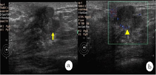 4个好习惯让你远离乳腺癌,多抚摸有助于预防乳腺癌么