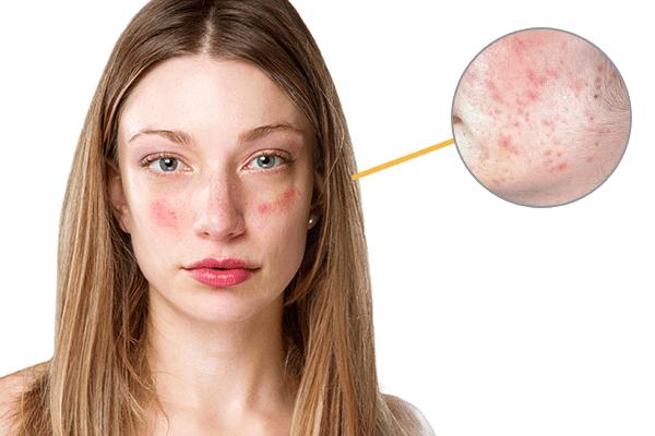 脸部过敏发红发痒怎么用药,脸部发红发痒过敏了怎么办