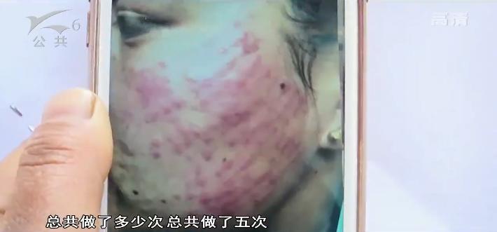 去除唇周黑在医院花多少钱,医院人员说不可以退款怎么办