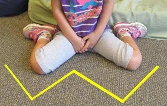 宝宝x型腿怎么走路有助矫正,2岁宝宝x型腿矫正正确方法