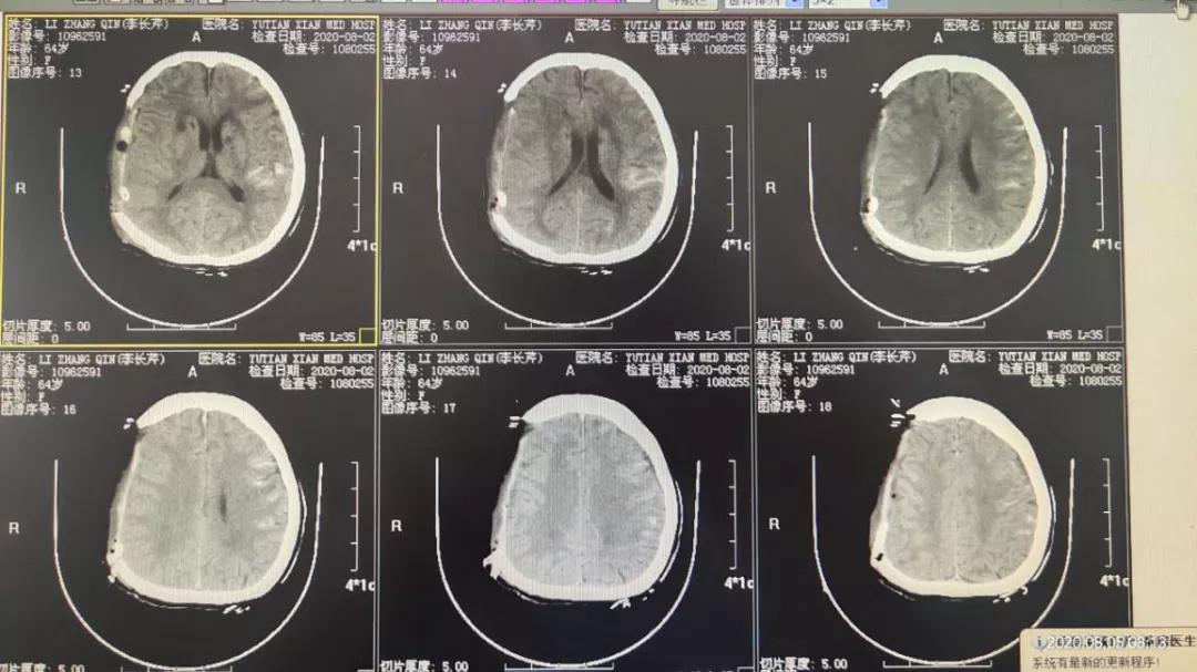 玉田县中医医院脑病四科成功抢救脑疝患者