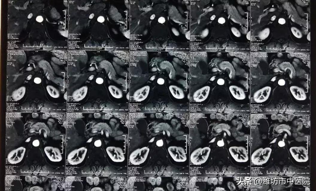 肺癌晚期肝转移肾转移能活多久,肺癌晚期肾转移有哪些表现