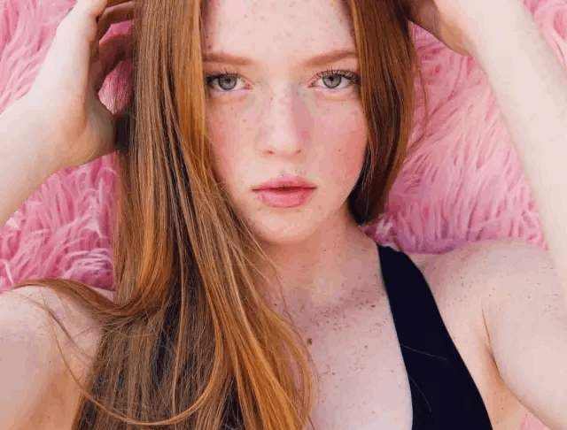 色斑的科普小知识|种类、形成的原理及因素