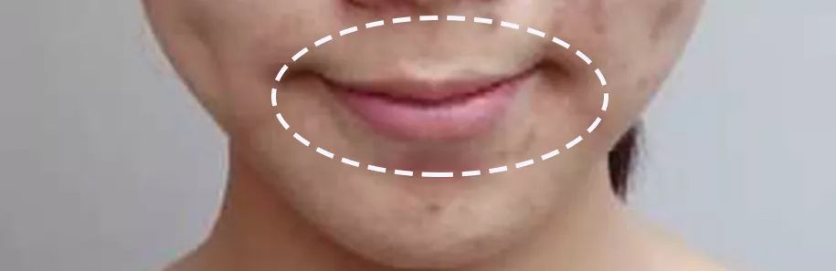 求改善痘痘真实办法,想改变脸上痘痘