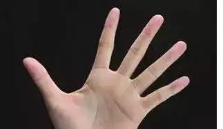 防治脑血栓的穴位,脑血栓怎么防止