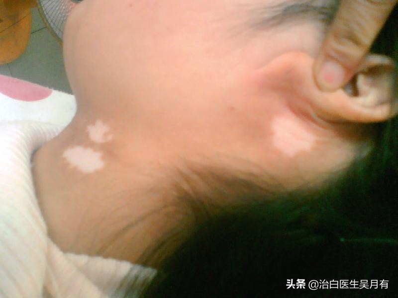 孩子得了白癜风如何护肤,孩子白癜风怎么治疗有效