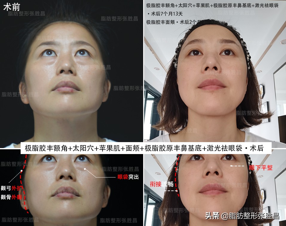 做脂肪填充面部以后变胖了,做脂肪面部填充会变美吗