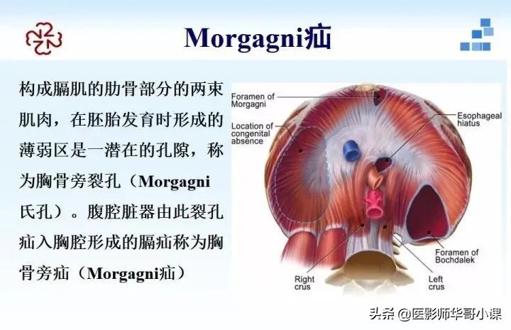 「精品课件」胸部膈肌的解剖及常见病变影像的表现