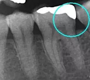 补牙树脂修复牙齿,大连市口腔医院牙齿修复