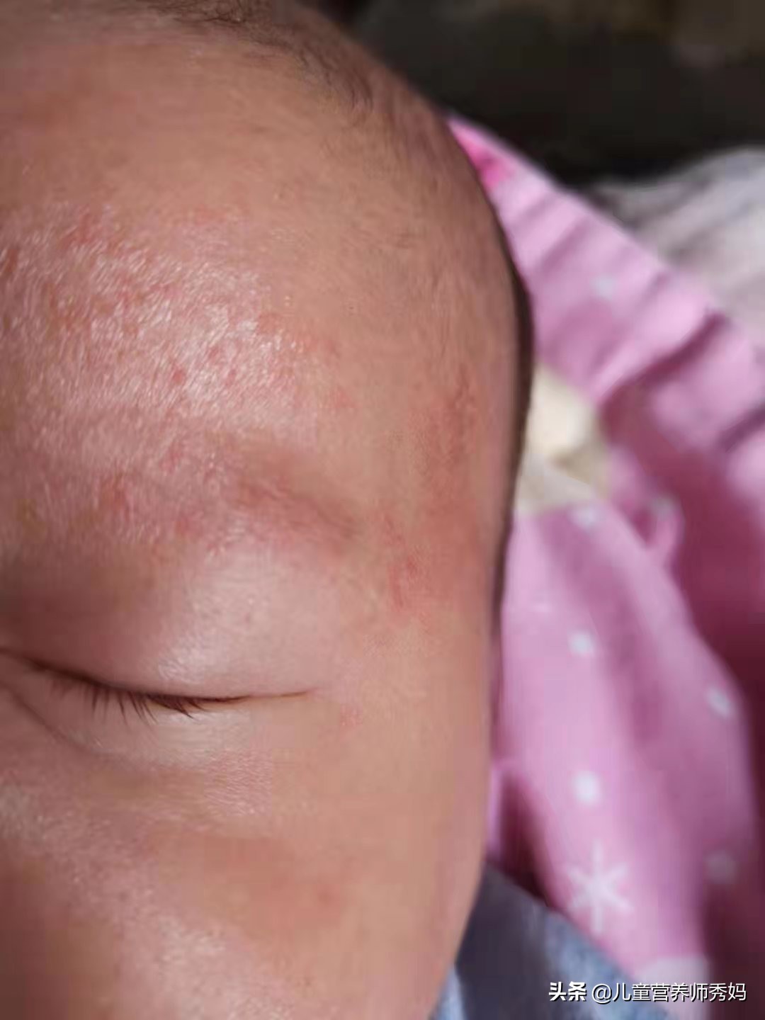 宝宝起湿疹怎么办最有效,宝宝湿疹怎么办才好得快