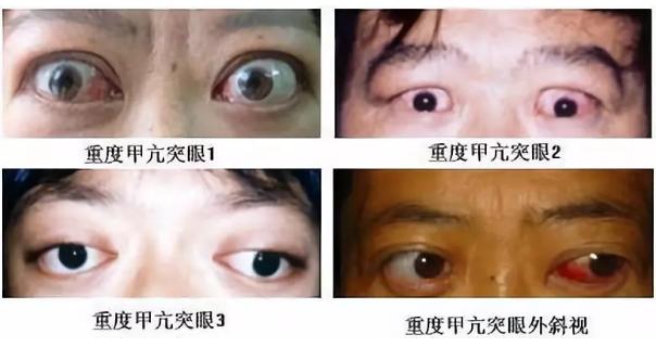 甲亢性眼突婴儿,8岁的小孩得了甲亢能自愈吗