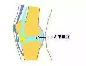 膝关节滑膜炎怎么办好得快,膝关节得了滑膜炎应该怎样恢复