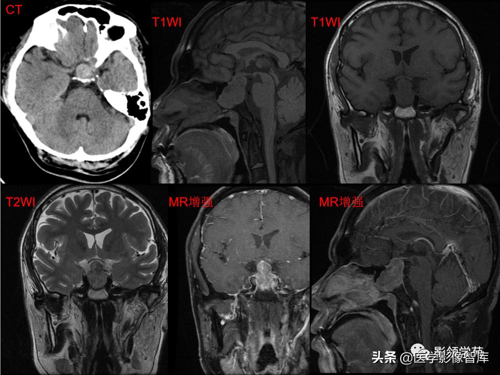 鞍区肿瘤做什么检查得出来,鞍区肿瘤的影像学鉴别