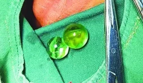 5岁女童自己*体下**塞进“异物”，吓坏妈妈，医生：性教育越早越好