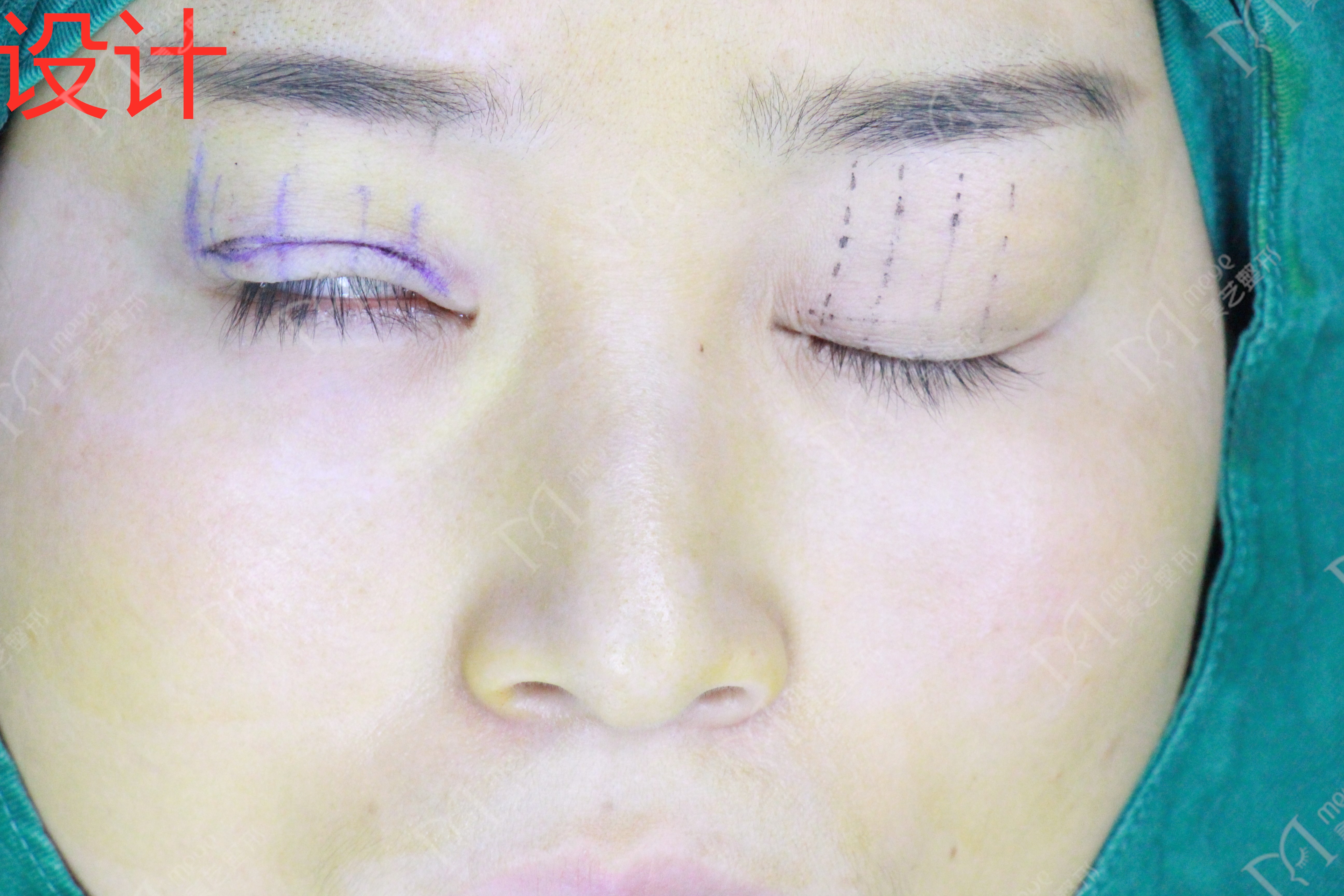 女子双眼皮术后大小眼,大小眼做了双眼皮感觉眼角不对称