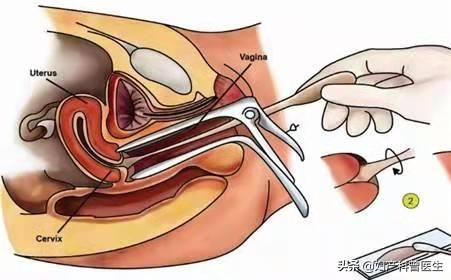 20多岁患宫颈癌的几率,宫颈癌筛查需要做宫颈刮片么