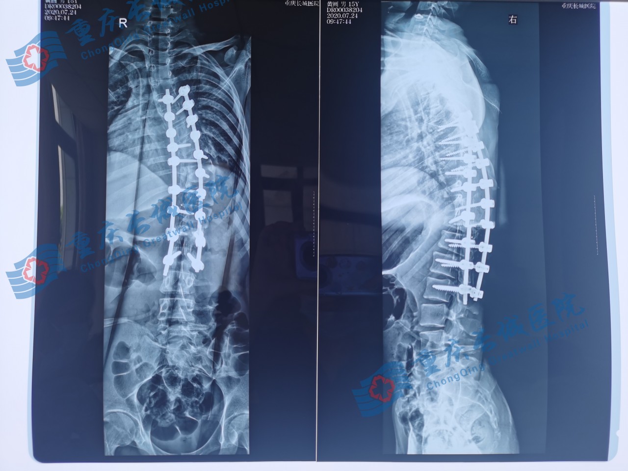 关爱脊柱健康儿童脊柱侧弯,关注脊柱侧弯让孩子少走弯路