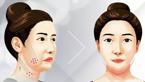30岁下颌缘提升还有用吗,30岁下巴后缩能矫正吗