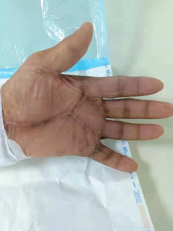 钓鱼饵料引起手上起泡脱皮开裂,钓鱼饵料导致手严重脱皮怎么办