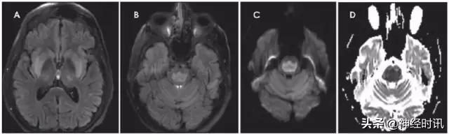 脑卒中的快速识别ppt,脑卒中神经影像学实例解析