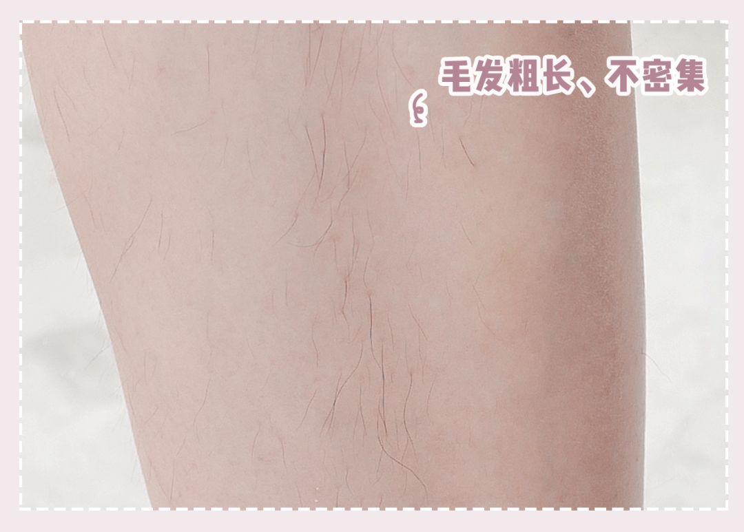 体毛脱毛的效果怎么样,天生体毛旺盛的人正常吗