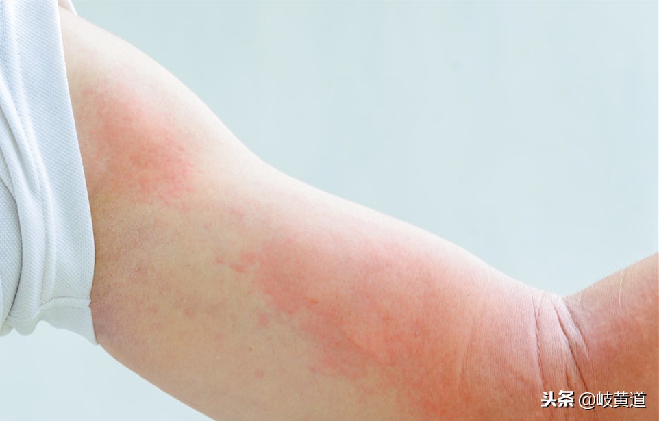 皮肤起红疙瘩荨麻疹怎样治疗,为什么皮肤发红疹荨麻疹不能治好