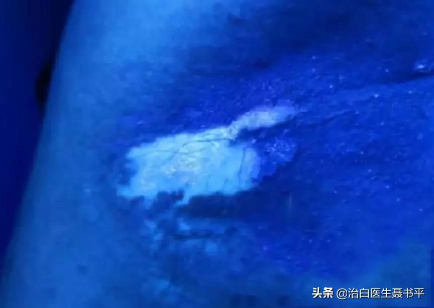 医生无法确定无色素痣还是白癜风,无色素痣误诊白癜风