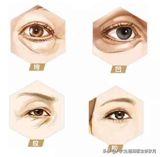 眼部细纹和眼袋泪沟怎么去除,赶走泪沟眼袋眼干没细纹