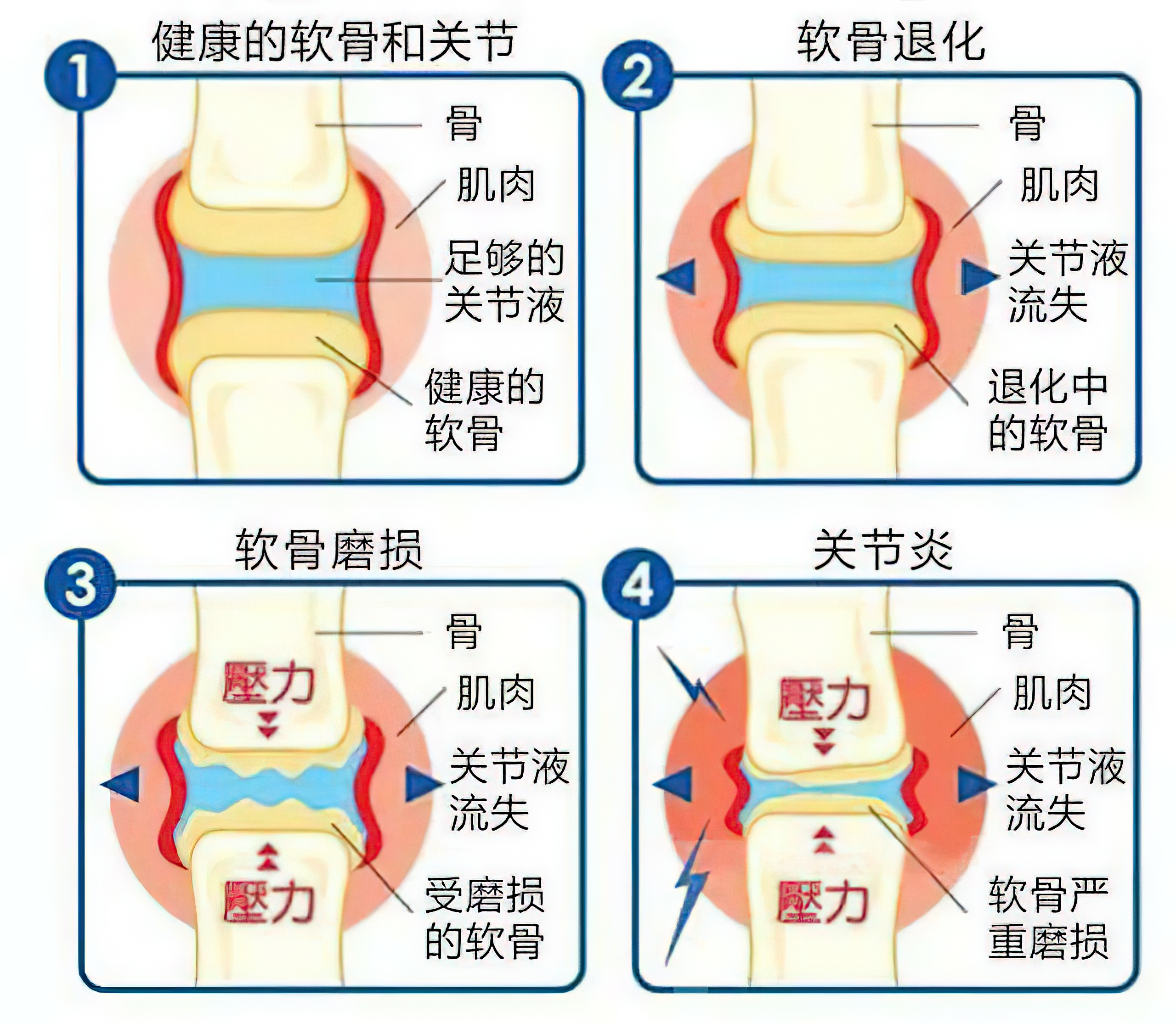 骨关节炎疼痛可以吃什么药,骨关节炎疼痛解决不了怎么办