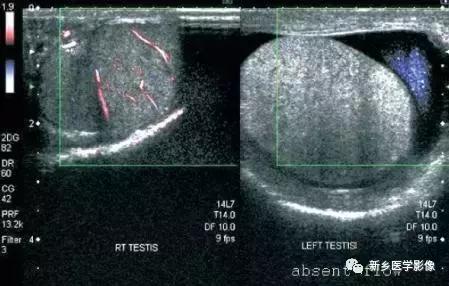 睾丸内部病变,睾丸病变mri
