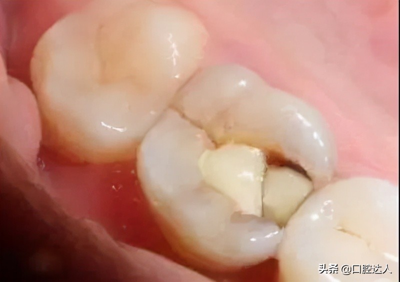 牙齿内侧根部掉了一小块怎么办,牙齿顶端掉了一小块可以磨平吗
