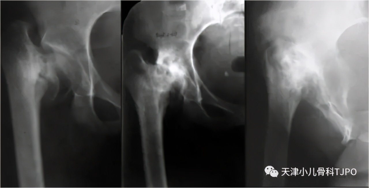 小儿先天性髋内翻名词解释,小孩走路颠足内翻