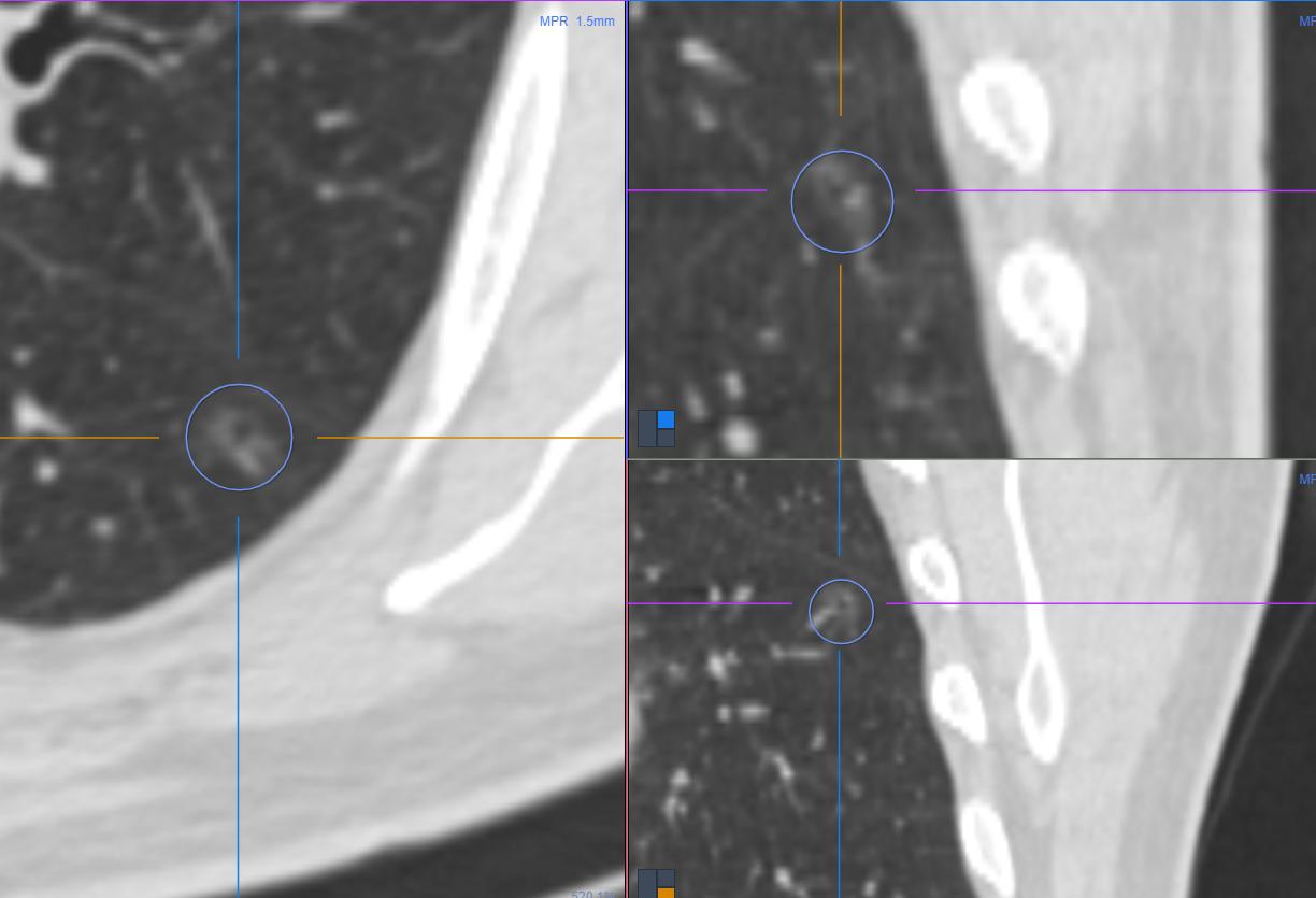 肺结节看诊（七）：这个肺结节手术太及时，空泡征小结节要注意