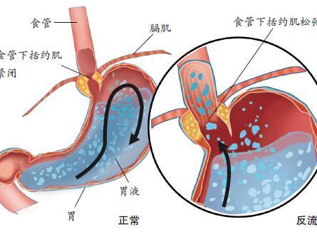 什么是霉菌性食道炎？得了霉菌性食道炎主要有哪些症状？