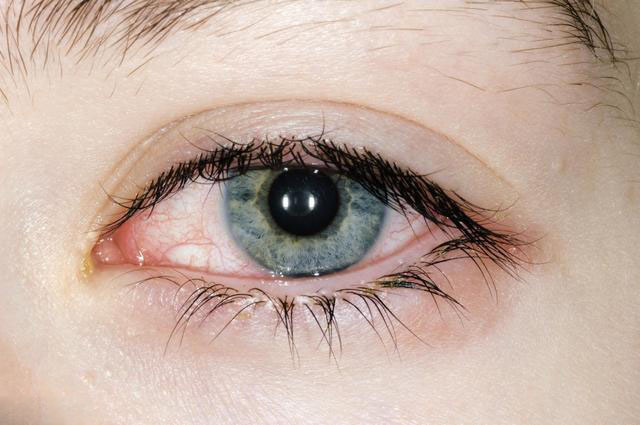 眼外伤眼底好就能角膜移植吗,哪种眼病才做穿透性角膜移植