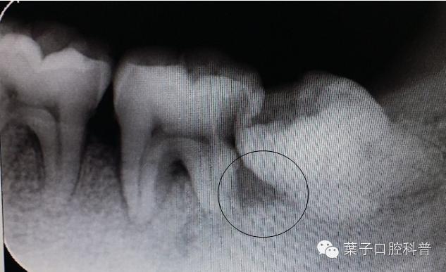 拔智齿：讳疾忌医有什么后果？#葉子口腔科普#
