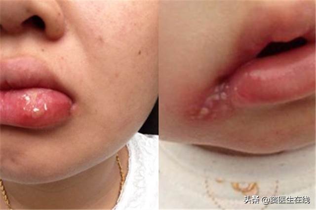 儿童单纯疱疹的危害,单纯疱疹会影响孩子么