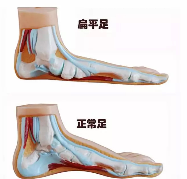 扁平足不疼是后天还是先天,扁平足是脚趾没发力导致的吗