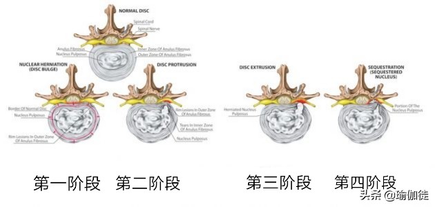 怎么练瑜伽才能缓解腰椎间盘突出,腰椎间盘突出怎么练瑜伽恢复