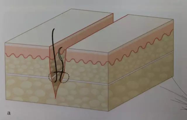伤口闭合的正确方法,伤口清创的详细步骤