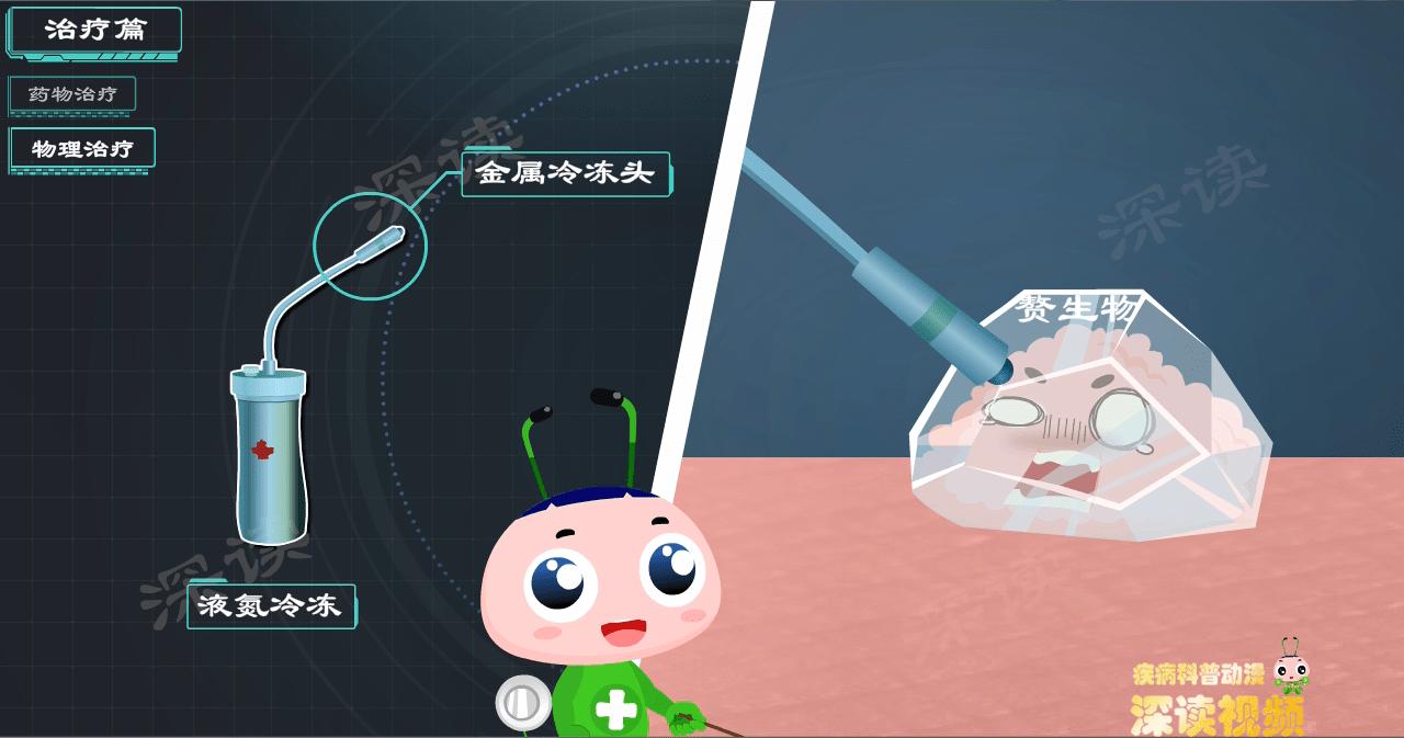 液氮冷冻治疗尖锐湿疣,冷冻和激光治疗尖锐湿疣的效果