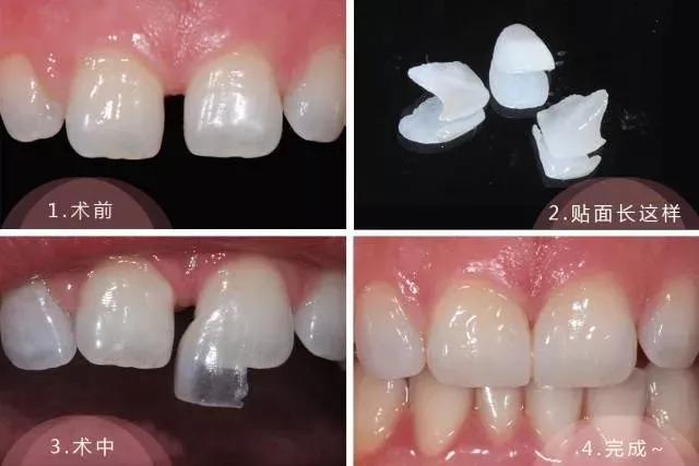 明星的牙都是真牙吗,如何辨别优秀的牙医