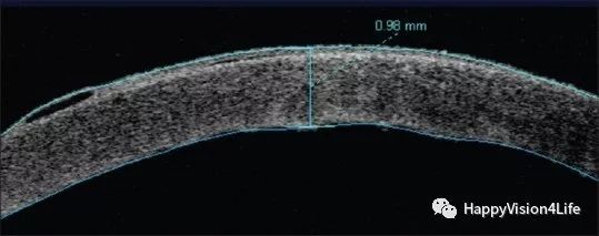 洞察超乳术后角膜的水肿