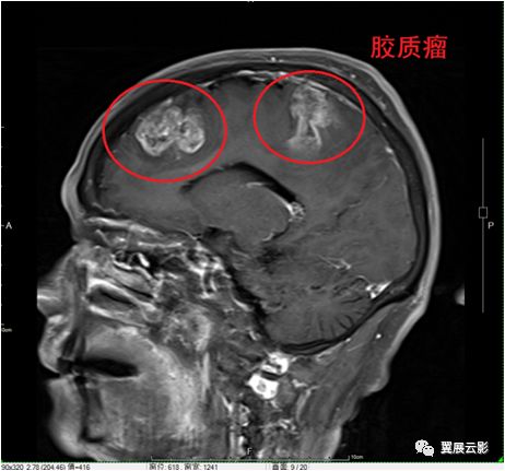 脑部脓肿怎么治疗,多发性脑脓肿能自愈吗